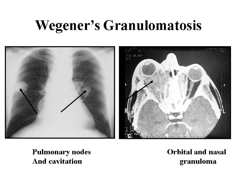 Wegener’s Granulomatosis Orbital and nasal granuloma      Pulmonary nodes And